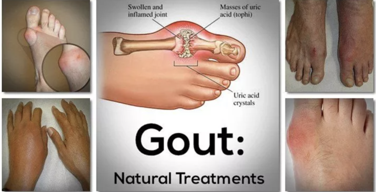 punca gout dan ubatnya